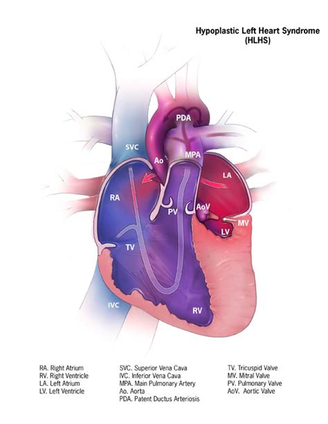 Hypoplastic Left Heart Syndrome Pediatric Echocardiography
