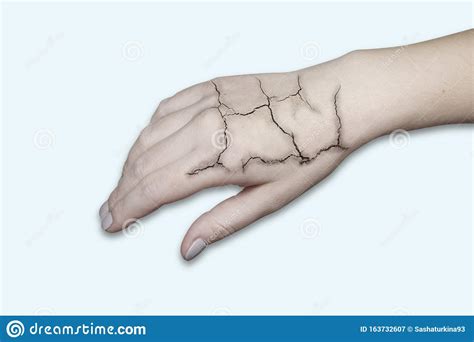 Hand With Cracked Skin Cracked Skin Dry Skin Stock Image Image Of