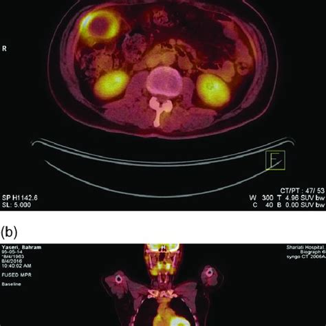 Fdg Pet Ct With A Trans Axial And B Coronal Views Pet Ct Scan