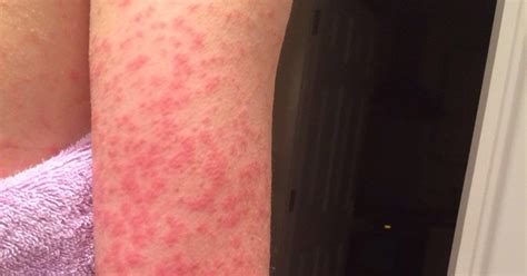 Rashes Can Be A Better Sign Of Having Covid 19 Than Fever Or Cough