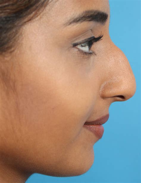 rhinoplasty toronto best nose job in toronto