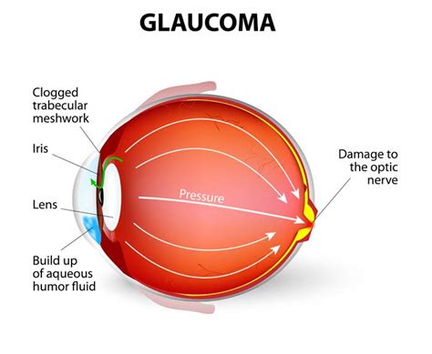 Symptoms can vary based on the severity of your condition and the type of glaucoma. Glaucoma: Symptoms, Causes, Treatments - Medical News Today