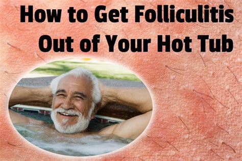 How To Get Folliculitis Out Of Your Hot Tub