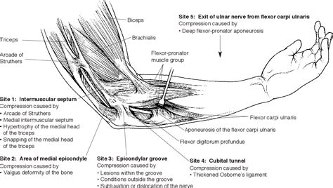 Figure 1 From Compressive Ulnar Neuropathies At The Elbow I Etiology