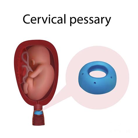 Cervical Pessary Photograph By Veronika Zakharova Science Photo Library