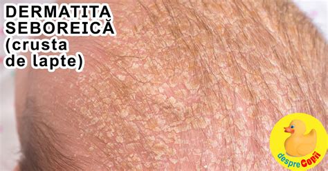 Dermatita Atopica La Copii Cauze Simptome Tratament Catena My Xxx Hot