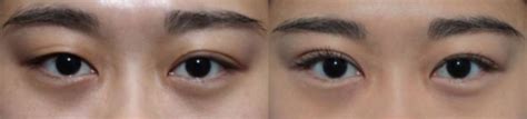 Non Incisional Double Blepharoplasty Eyelid Surgery For One Eyelid By