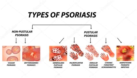 Tipos De Psoriasis Pustular Y No Pustular Vulgar Eritrodermia
