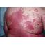 Plaque Psoriasis Symptoms  Dorothee Padraig South West Skin Health Care