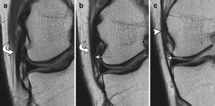 Mri Features Of The Anterolateral Ligament Of The Knee Springerlink