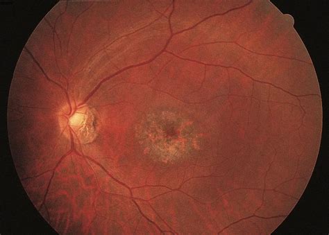 Macular Lesion American Academy Of Ophthalmology