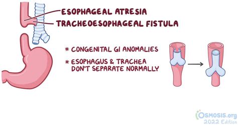 Rare Disease Education Esophageal Atresia And Tracheoesophageal Fistula