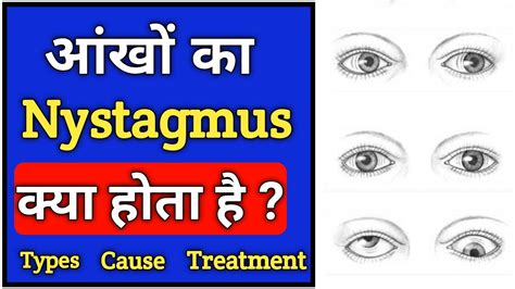 What Is Nystagmus Nystagmus Cause Types Diagnosis Treatment