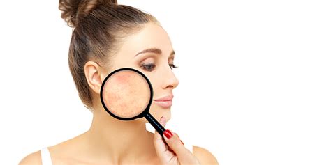 Blemishes On Face Causes Types And Treatments