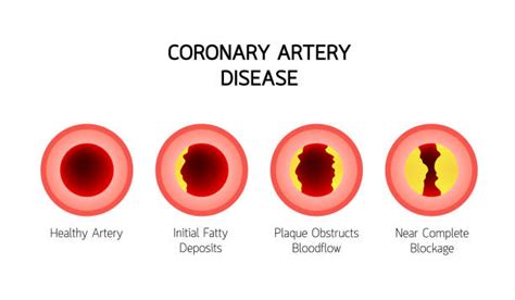 Best Human Artery Illustrations Royalty Free Vector Graphics And Clip