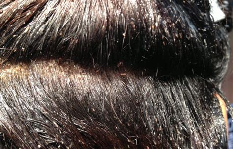 What Do Nits Look Like In Dark Hair 8 Lice Ideas Louse Head Louse