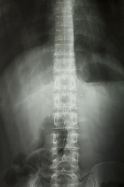 Radiografía De La Columna Espinal Foto De Archivo Imagen De Humano