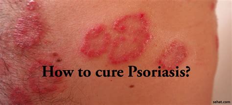 Tips To Cure Psoriasis Sehat