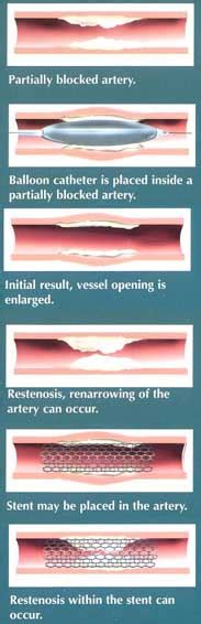Browse coronary artery disease templates and examples you can make with smartdraw. Coronary artery radiotherapy | UF Health, University of ...