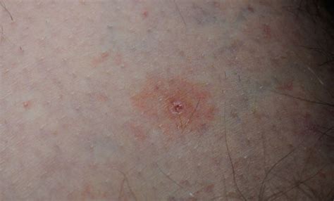 Tick Bite Rash Pictures Symptoms Causes And Treatment