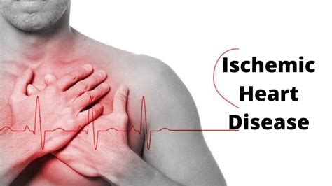 Ischemic Heart Disease Ihd Causes Symptoms Treatment And Diagnosis