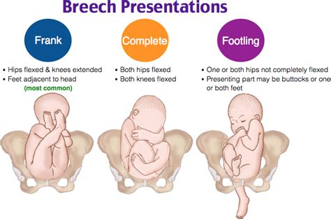 Define Breech Presentation Medical