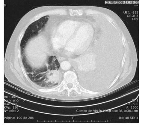 August 2009 The Ct Scan Showed A Growth Of Lung Metastases And Massive