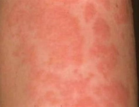 How Common Are Hives As A Symptom Of An Allergic Reaction Quora