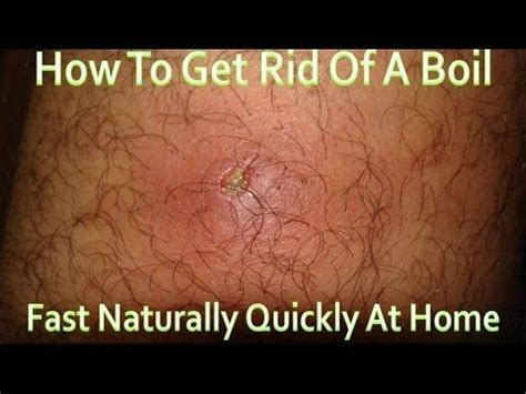 If they become infected, they can morph cysts may appear as big boils or lumps. Tips To Keep Your Skin Young And Beautiful | Ingrown hair ...