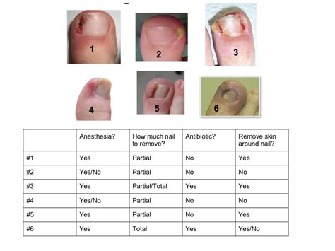 Proper Treatment Of Ingrown Toenail Dr Donald Pelto