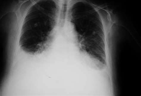 Predictors Of Pulmonary Edema In Pah Following Prostacyclin Therapy