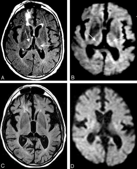 Axial Flair A And Diffusionweighted Images B From The Initial Mr