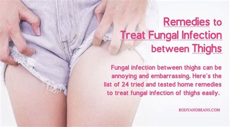 Fungal Infection Between Thighs Can Be Annoying And Embarrassing