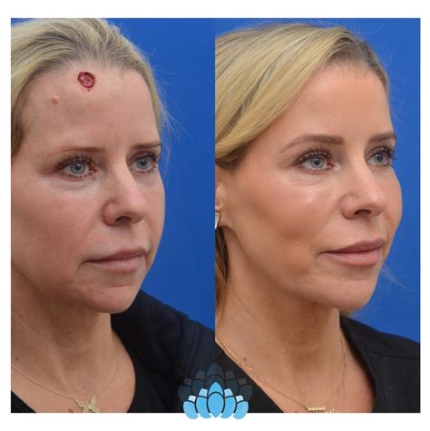 Mohs And Skin Cancer Surgery Before And After Pictures Case 20 Charlotte Nc Dilworth Facial
