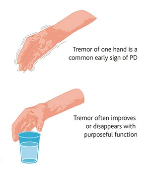 Hand tremors can occur for a variety of reasons. Tremors - symptoms, causes, diagnosis, Tremors treatment