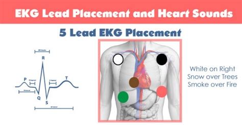 5 Lead Ecg Placement Mnemonic