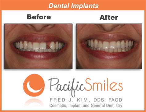 How Do Dental Implants Work Pacific Smiles Dental Implant Center