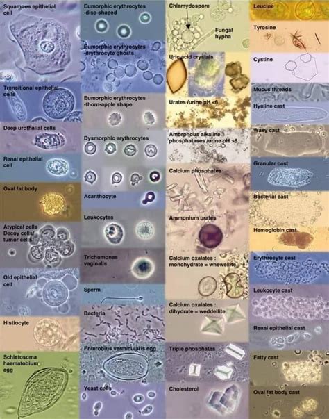 Types Of Cells In Urine Microscopy