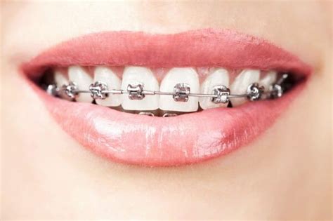 The Damon System Comprehensive Guide To Self Ligating Braces