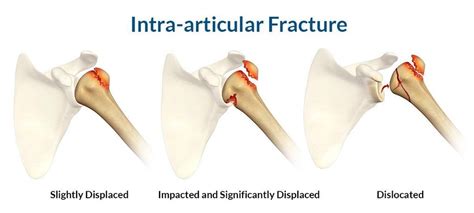 Intraarticular Fractures Diagnosis And Treatment Information Guide