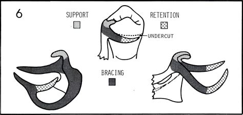 Removable Partial Denture Design Pocket Dentistry