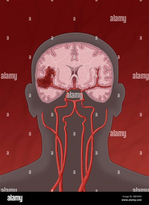 Laccident Vasculaire Cérébral Hémorragique Illustration Photo Stock