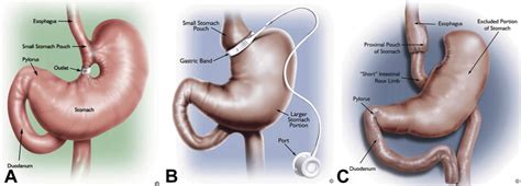 The Role Of Endoscopy In The Bariatric Surgery Patient
