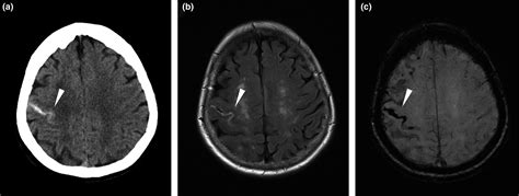 Cerebral Amyloid Angiopathy Review Of Clinico‐radiological Features