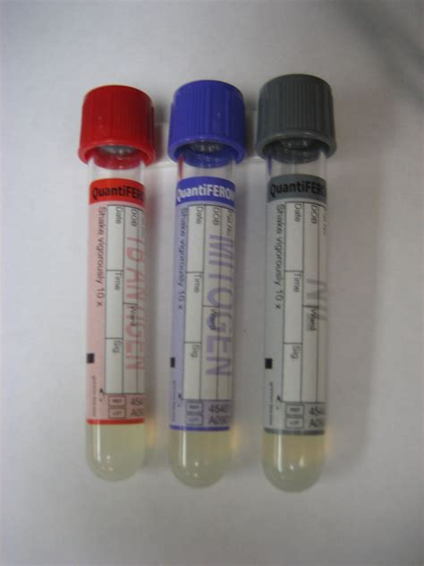 Lab Test Quantiferon Tb Gold Blood Test
