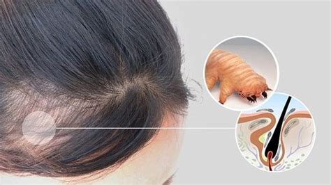 Demodex is a group of mites that can infest human hair follicles. Pin by Archie Petrie on beauty tips in 2021 | Face skin ...