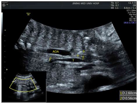 Diagnostic Accuracy Of Ultrasonography For The Prenatal Diagnosis Of