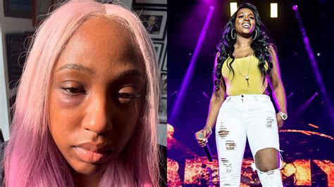 Brittney Taylor Shows Her Black Eye After Claiming Remy Ma Punched Her