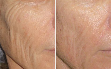 Radiofrequency Skin Tightening Renew Medical Aesthetics Cheshire