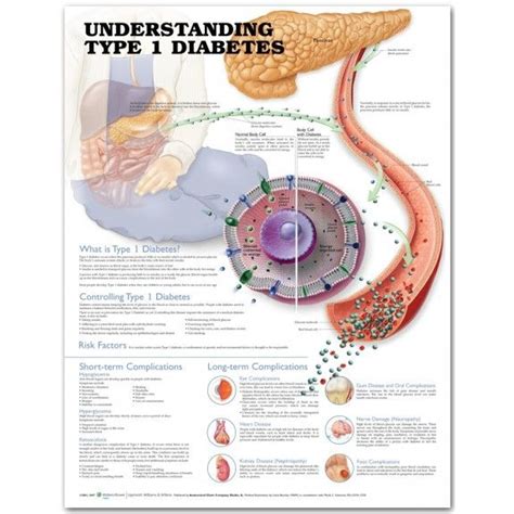 Understanding Type 1 Diabetes Poster Diabetes Anatomical Chart Co